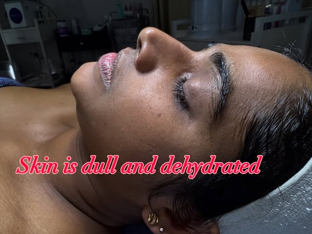Before and after dermaplaning