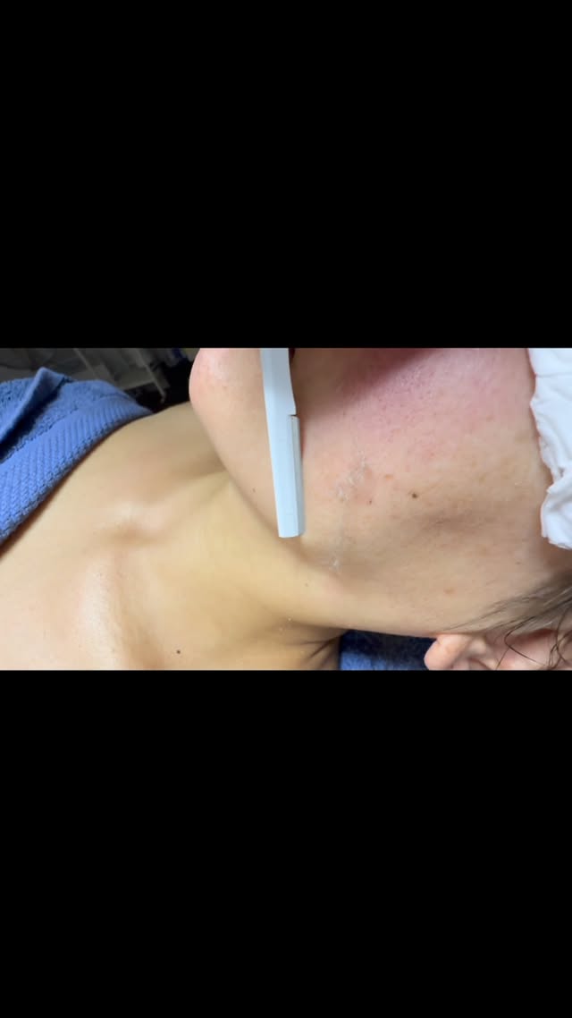 Dermaplaning detail